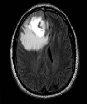 Figure 2 : MRI image of tumor affected and normal brain