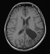 Figure 4: Adjusted the MRI image using the max intensity level