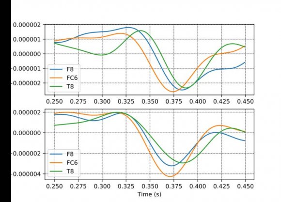 Figure8shows the ERPs for 3 EEG channels that are from the frontal and temporal regions of the brain involved in processing of auditory stimulus. The time delay in these evoked potentials can be clearly seen. Similarly, Figures9 and 10shows the time delays in the evoked potentials for a 4 and 8 direction auditory stimulation, respectively. In this case, the occipital and parietal lobes are involved. This shows that as more complex sounds are presented, different neuronal pathways are activated in processing these auditory stimuli.Figure11shows the time frequency representation for the 3 features for the 2 direction auditory ERPs. Figure12shows the topoplots for the EEG signals recorded during left and right direction auditory stimulation. Figures 13 to 15 shows the time frequency representation for the 3 features for the EEG signals evoked by auditory stimulation in 4 directions.